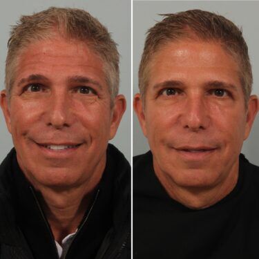 Male Injectables Earlier than-and-After Images: Botox and Filler