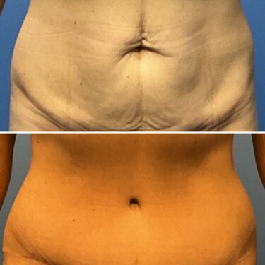 Tummy Tuck Earlier than-and-After Pictures: Actual Affected person Outcomes