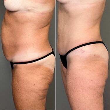 Dr. Mays tummy tuck patient