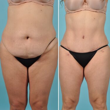 Tummy tuck case before and after Dr. Alfonso