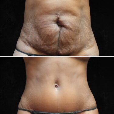 Dr. Levine abdominoplasty before and after
