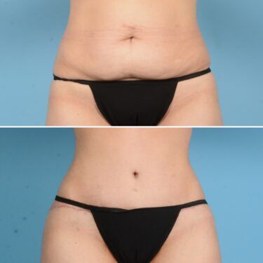 Abdominoplasty tummy tuck Newall