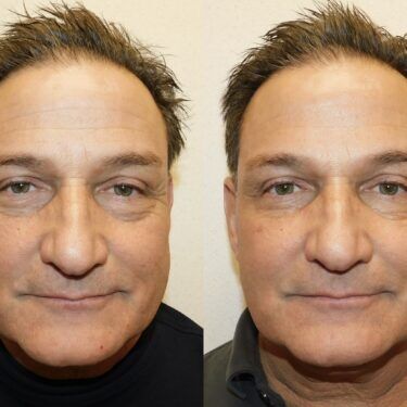 Schlessinger Male Injectables Gallery