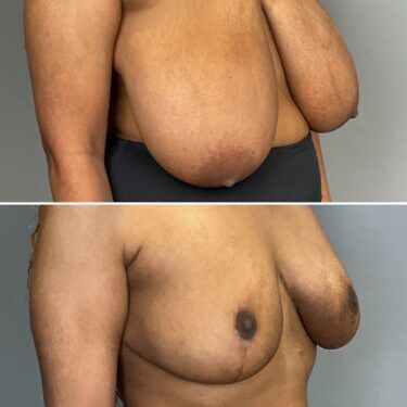 Breast Reduction and Lift before after gallery Dr. Mays