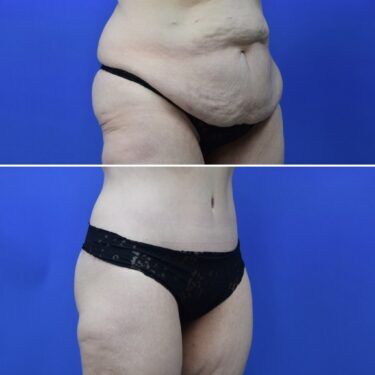 Dr. Bachilo abdominoplasty before and after tummy tuck