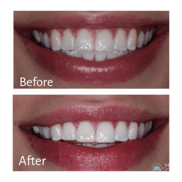 Teeth Whitening, Nathan Hoffman, DDS