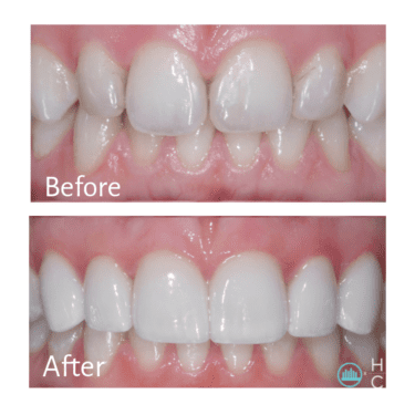 Teeth Whitening, Nathan Hoffman, DDS