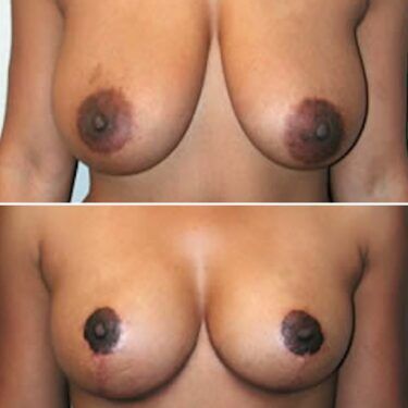 Awada Breast Lift gallery before and after