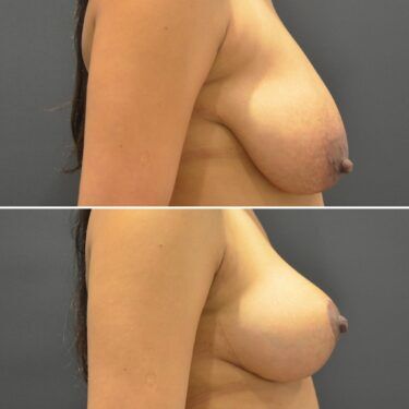 Preminger Breast Lift patient before and after