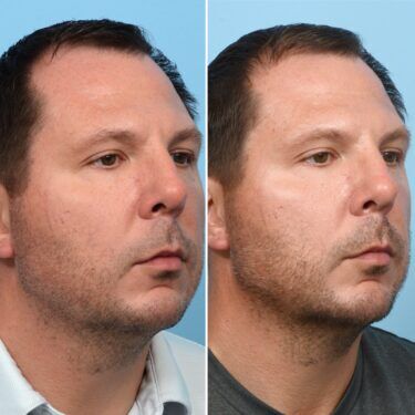 Juvéderm filler