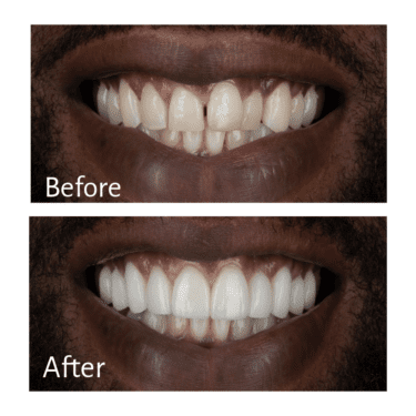 Veneers Before and After