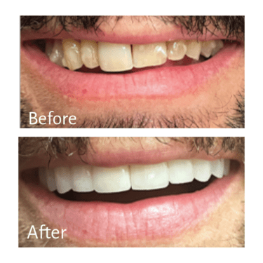 Veneers Before and After