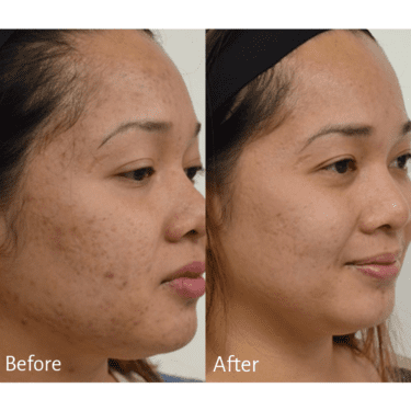 Microneedling Earlier than and After Pictures You Need to See