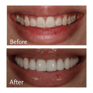 Veneers Before and After
