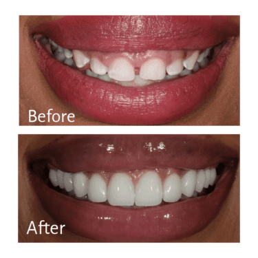 Veneers Before and After