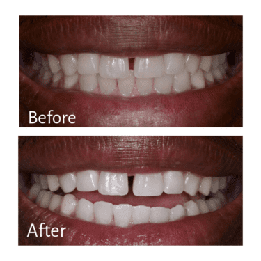 Treatment: Zoom! Whitening, Practitioner: Guy M. Lewis, DDS