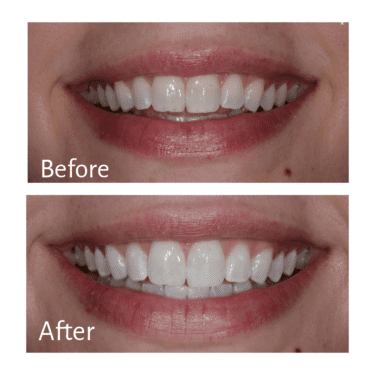 Treatment: Zoom! Whitening, Practitioner: Guy M. Lewis