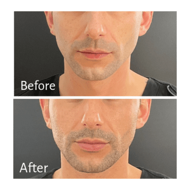 Practitioner: Dr. Janet Allenby, Treatment: Chin Filler with Restylane