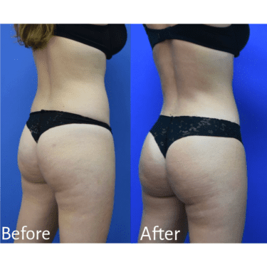 BBL Earlier than-and-After Images Present Main Transformation