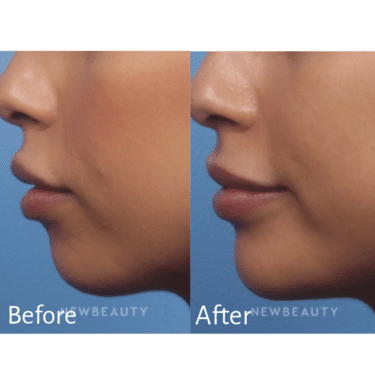 Practitioner: Dr. Kelly Bomer, Treatment: Chin Filler with Radiesse
