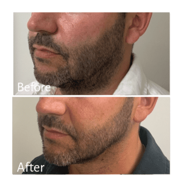 Practitioner: Dr. Doris Day, Treatment: Chin Filler