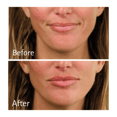 Practitioner: Dr. Deborah Longwill, Treatment: Chin Filler