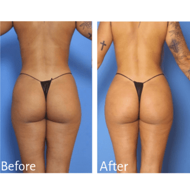BBL before and after Practitioner: Dr. Gordon M. Kaplan, Procedure: Liposuction, BBL