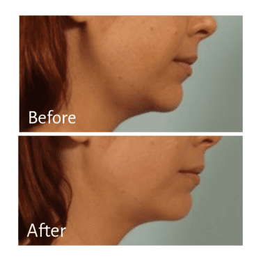 Practitioner: Dr. Kenneth Beer, Treatment: Chin Filler