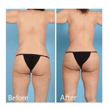 BBL Before and After Practitioner: Dr. German Newall, Procedure: Liposuction and BBL