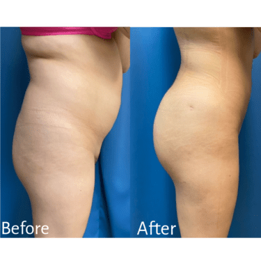 BBL Before and AFter Practitioner: Dr. Michael J. Orseck, Procedure: Liposuction and BBL