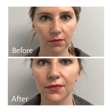 Practitioner: Dr. Marina Peredo, Treatment: Chin Filler