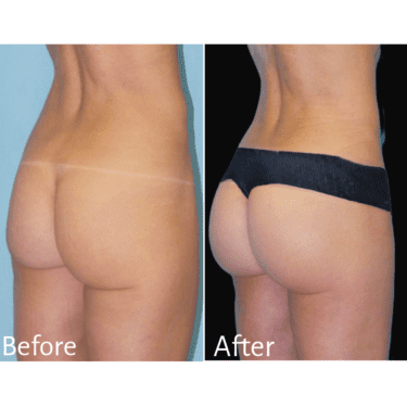 BBL Before and After Practitioner: Dr. Sean Simon, Procedure: BBL and Liposuction