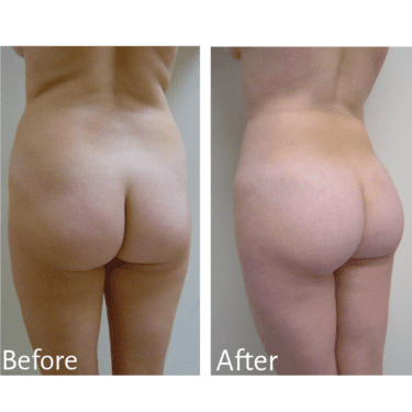 Practitioner: Dr. Sean Simon, Procedure: BBL and Liposuction