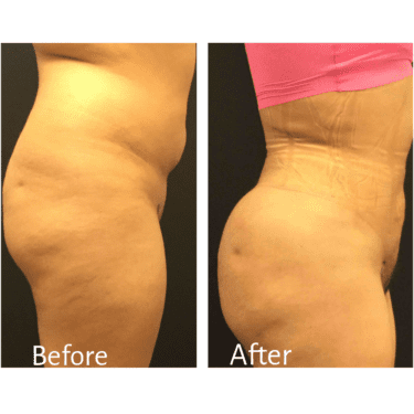 BBL Before and After Practitioner: Dr. Amy Sprole, Procedure: BBL