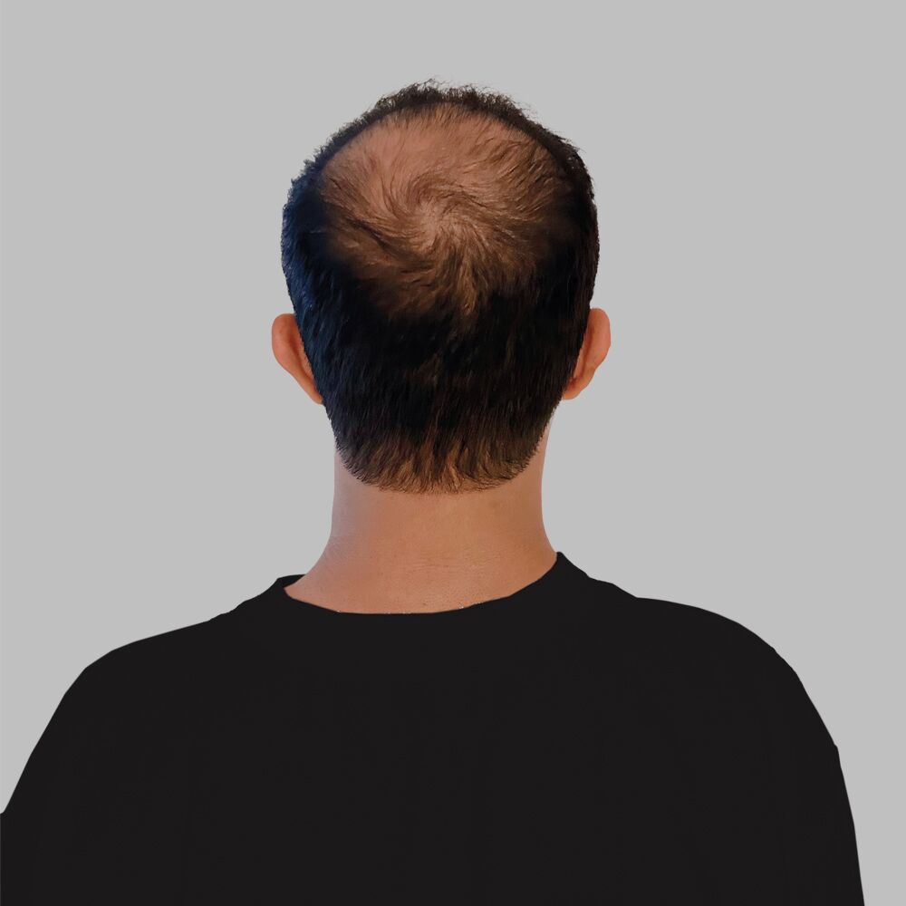 Again to Hair, Again to Me: A Hair Restoration Story