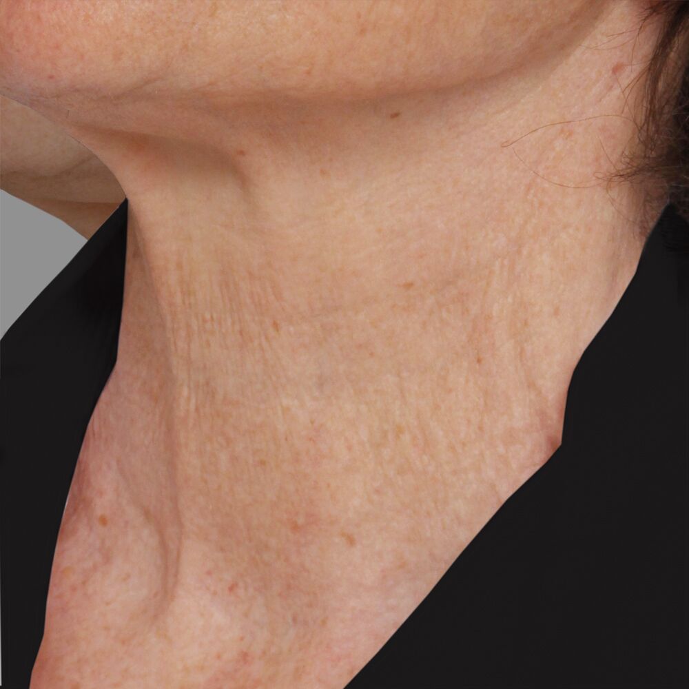 after skin-tightening treatments and Botox Cosmetic