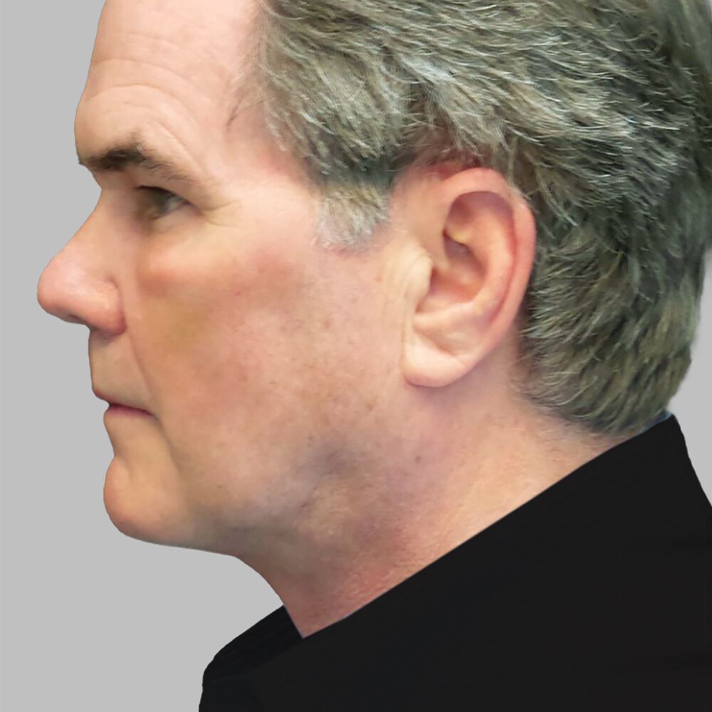 after lower facelift and necklift