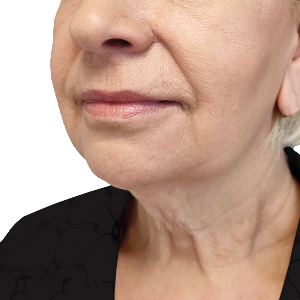 before deep-plane facelift and necklift