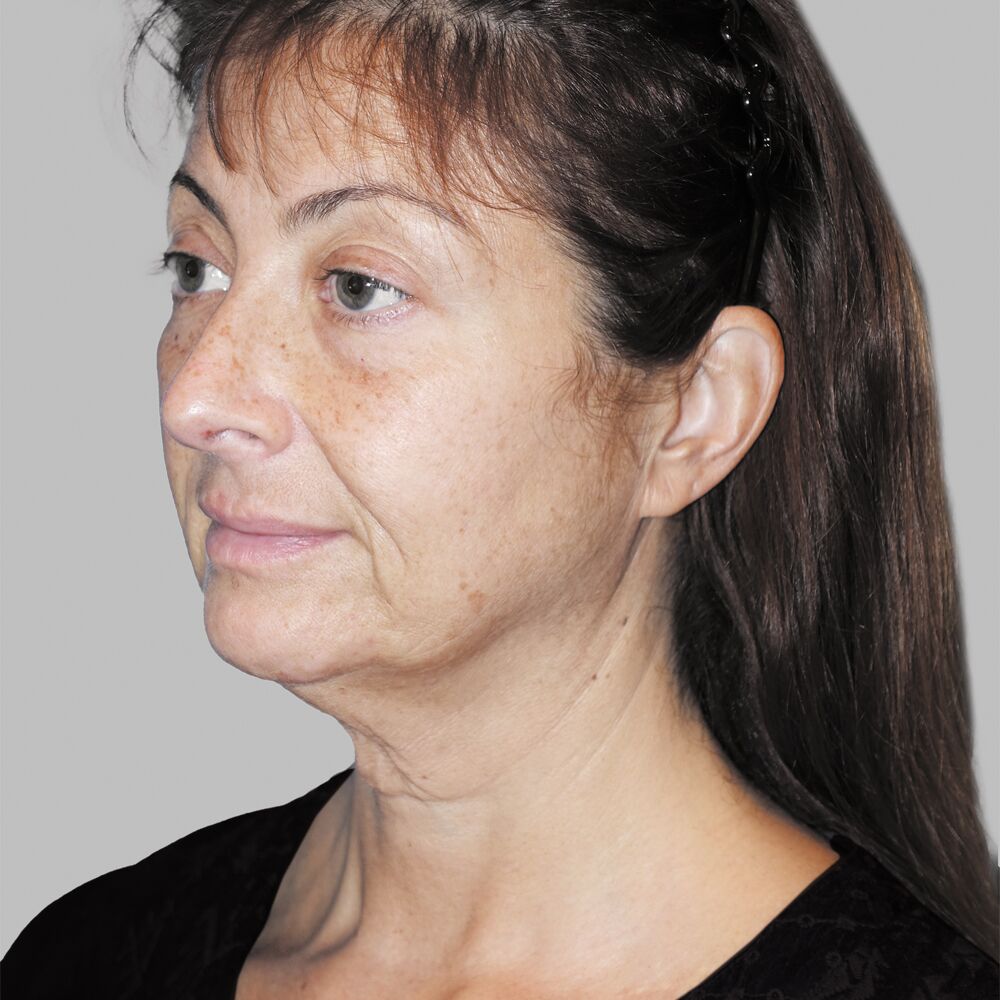 before deep-plane facelift and necklift, combined with Fraxel and Morpheus8