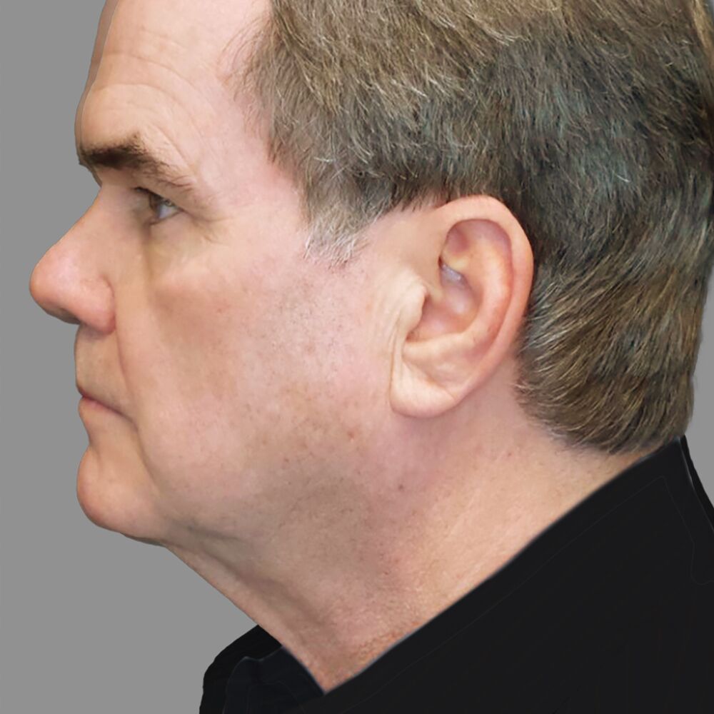 before lower facelift and necklift