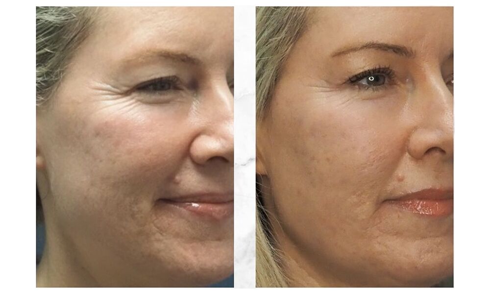 This Needle-Free Remedy Smoothed My Zits Scars – Beauty