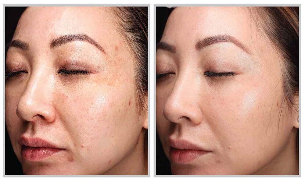 The Beloved HALO Laser Simply Obtained an Improve – Beauty