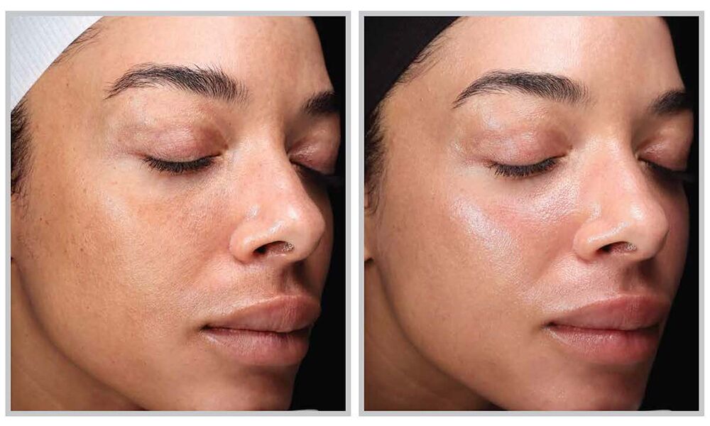 The Beloved HALO Laser Simply Obtained an Improve - Beauty 2 One week after a single HALO TRIBRID treatment.