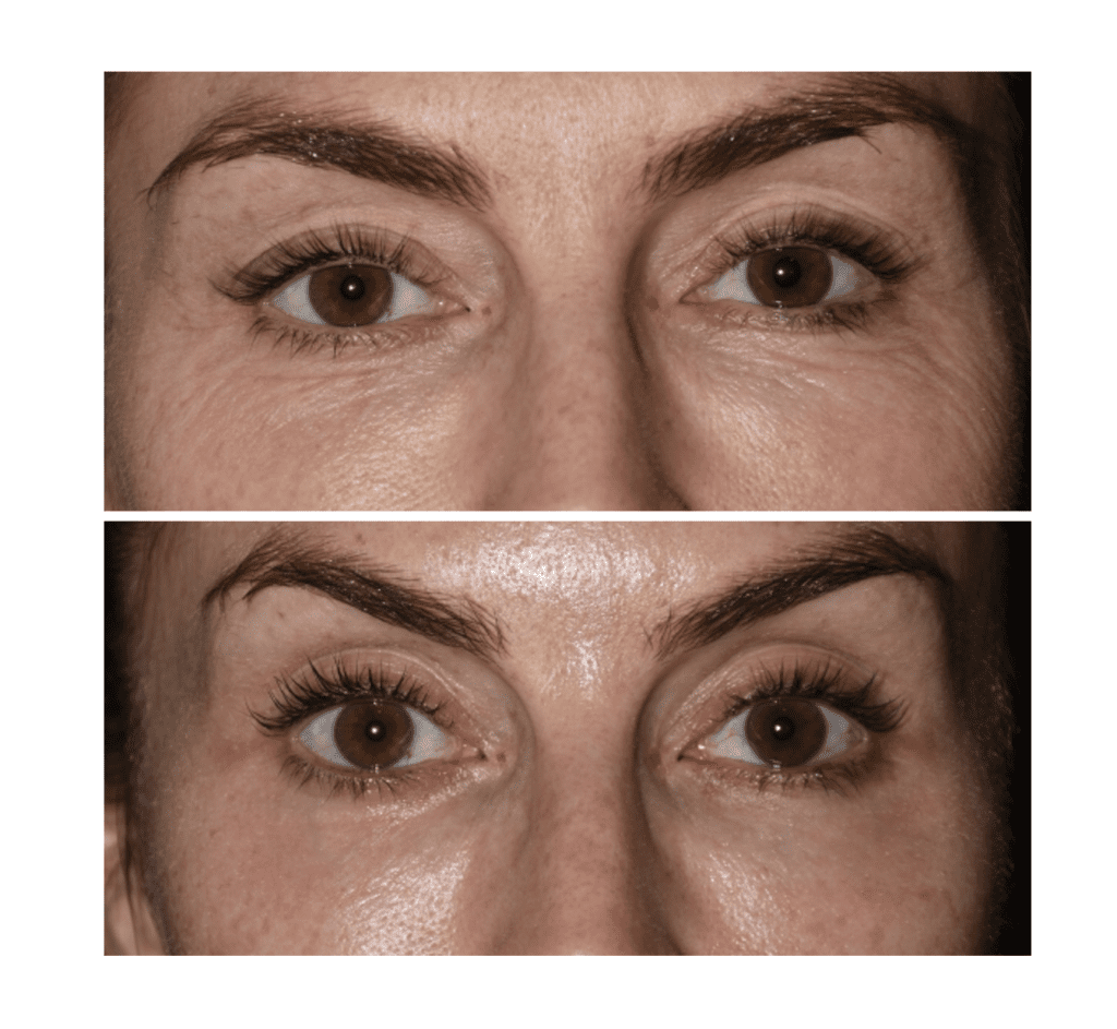 Before and after laser treatment