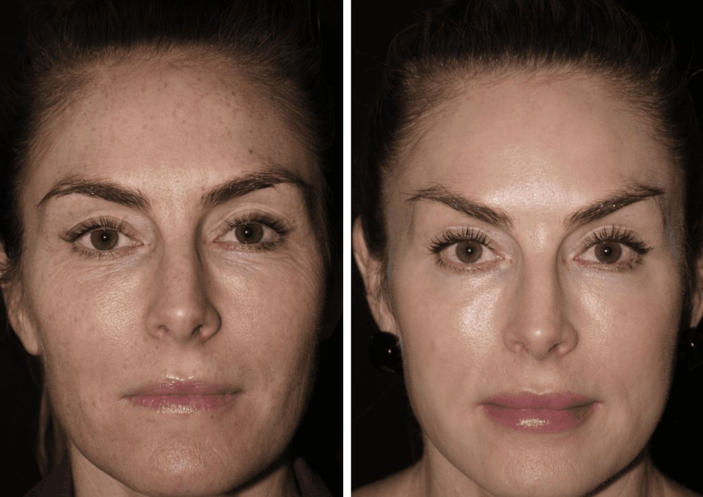 This Laser Remedy Is My Fast Repair for Tighter Pores and skin – Beauty