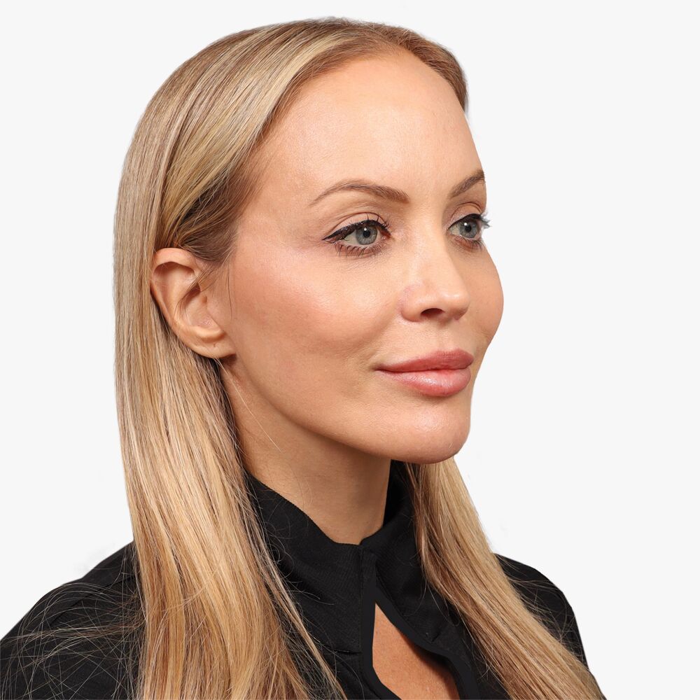 After browlift, facelift, necklift and fat transfer 