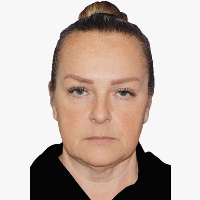 The Pre-Menopause Facelift Is Having a Second – Beauty