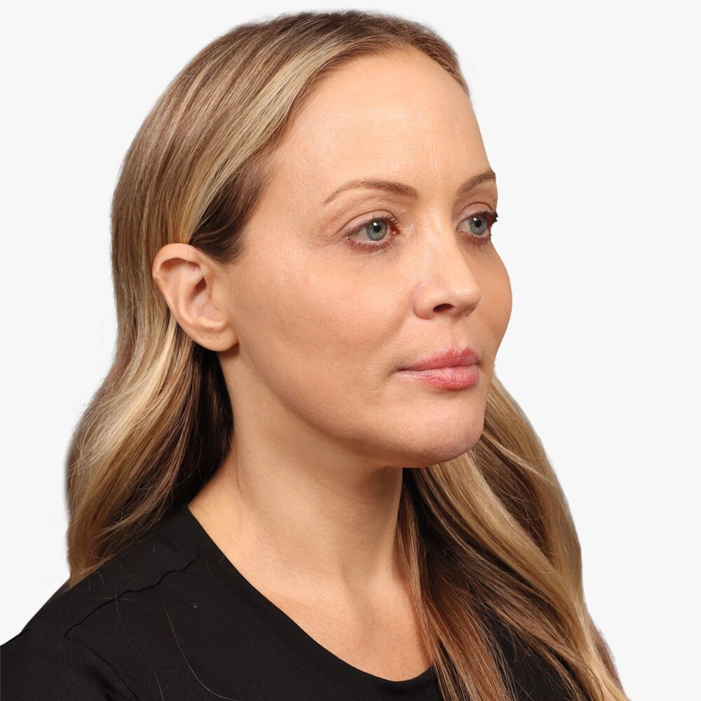 Before browlift, facelift, necklift and fat transfer 