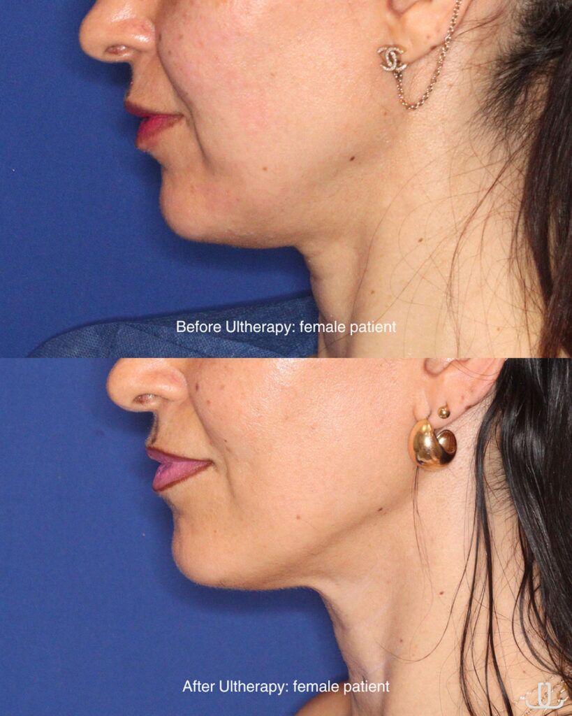 ultherapy before and after