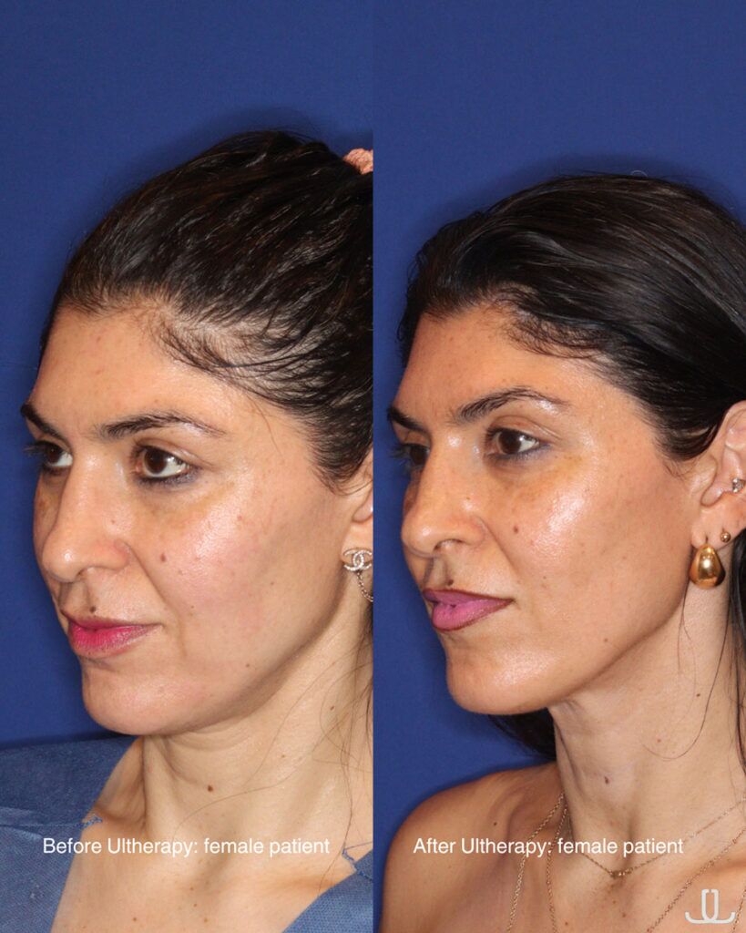 ultherapy before and after